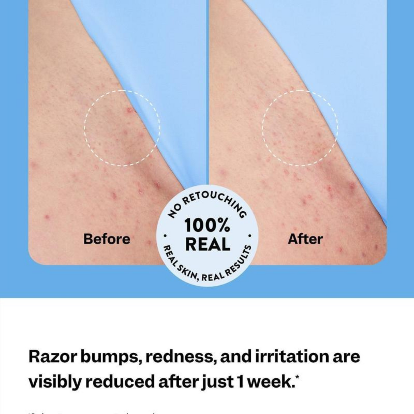 SilkGlide™ Ingrown Hair Treatment by VIMVY