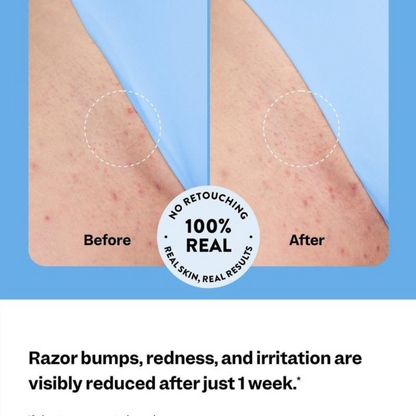 SilkGlide™ Ingrown Hair Treatment by VIMVY